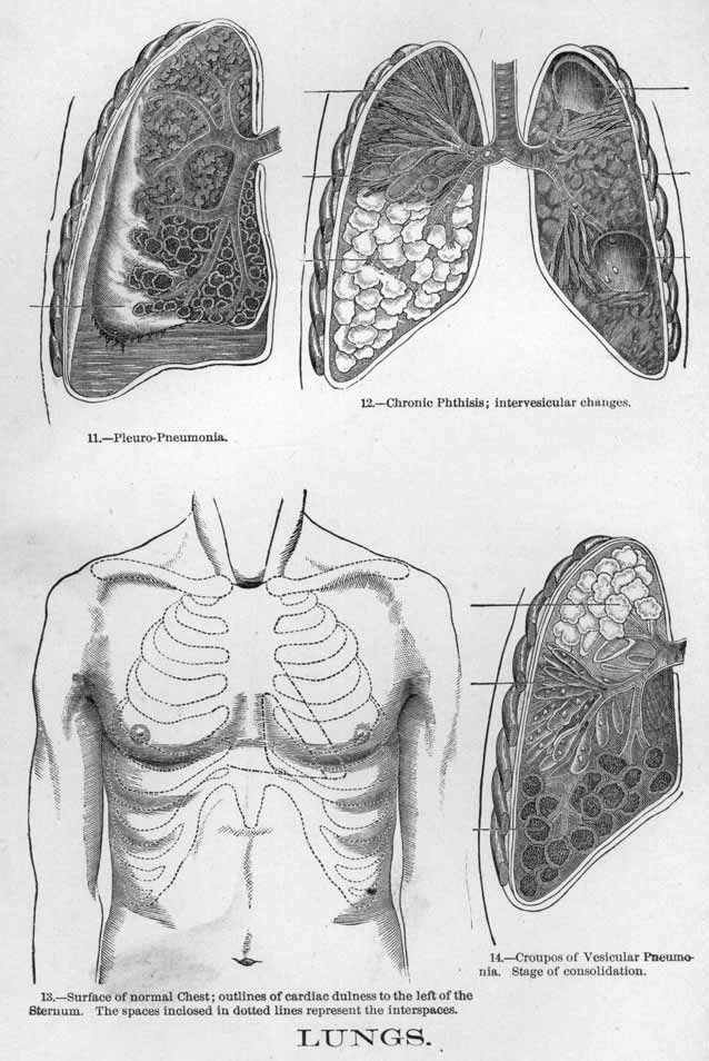 The lungs and how some diseases affect them